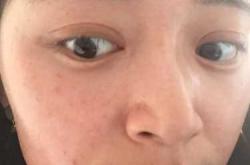 坐月子脸痒怎么办