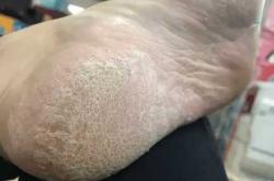 坐月子脚上脱皮是什么原因