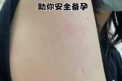 疫苗打完两针后多久能备孕