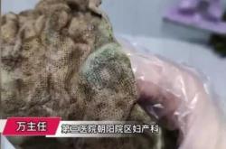 医院主张顺产背后有何原因