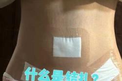 结扎后还能再怀孕吗