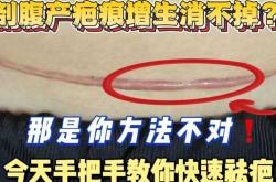 剖腹产疤痕是否都会增生