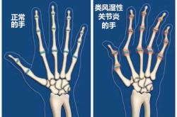 坐月子为何会得关节炎