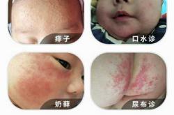 婴儿的湿疹是什么样子的