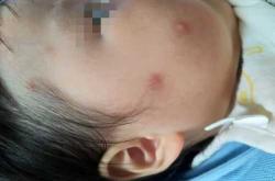婴儿丘疹图片啥样有何特征