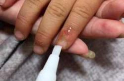 婴儿手指长倒刺怎么办