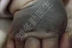 新生儿长痣是怎么回事