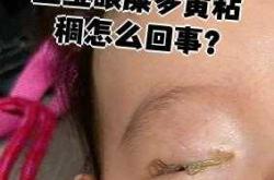 婴儿多眼屎是什么原因