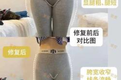 产后耻骨分离能自愈吗