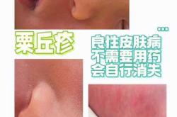 新生儿眼皮红斑图是怎么回事