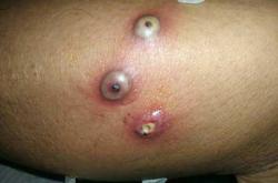 剖宫产术后高烧不退咋办