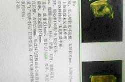 孕17周胆汁反流怎么办