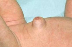 婴儿脐疝是什么