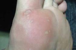 备孕用达克宁擦脚可以吗