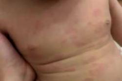 婴儿皮肤红疹怎么办