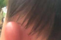 婴儿耳朵肿是怎么回事