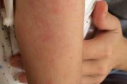 婴儿常见皮肤病图片有吗