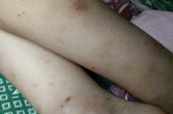 引产后身上痒怎么回事