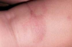 婴儿长癣的图片是怎样的