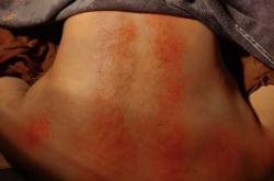 备孕前子宫能拔罐吗