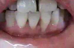 产后牙龈萎缩能恢复吗