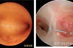 剖腹产后内膜多少厚度算正常