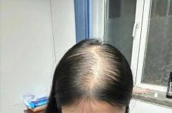 产后三个月脱发严重怎么办