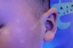 婴儿白癜风早期症状有哪些