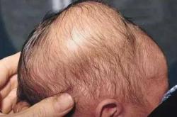 婴儿头部血肿该如何处理