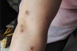 产后痒疹能自愈吗