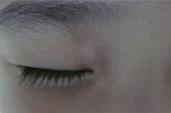 新生儿眼底白斑怎么回事