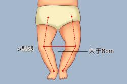 纸尿裤会导致宝宝0型腿吗
