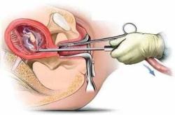 引产后更容易怀女孩吗