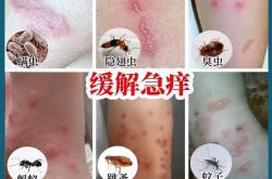 婴儿丘疹怎么办