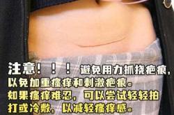 剖腹产一年后伤疤图片什么样