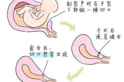 剖宫产后为什么要吸氧