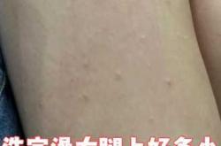 产后皮炎的原因是什么