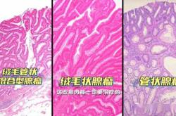 产后侧切口长息肉有图片吗