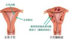 腺肌瘤怀孕胎儿能保住吗