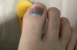 新生儿指甲发黑咋回事