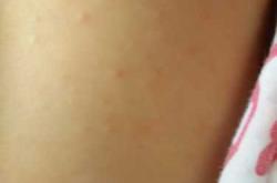 婴儿长痘是怎么回事