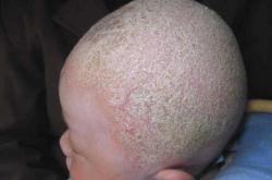 新生儿撞到头怎么办