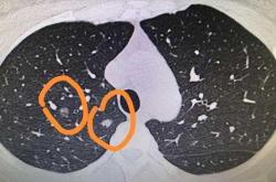 产后羊肠线排出是怎样的