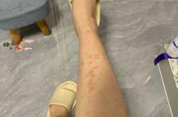 产后下面痒怎么回事