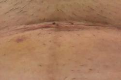 剖腹产刀口出现脂肪液怎么办