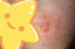 尿不湿过敏什么样