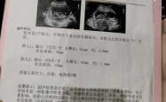 彩超做多影响备孕吗