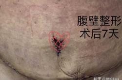 剖腹产刀口上方有赘肉咋办