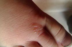 新生儿脚底发紫咋回事