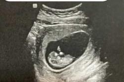 轻度孕反是怀男孩的征兆吗